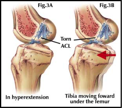 ACL-injuries1