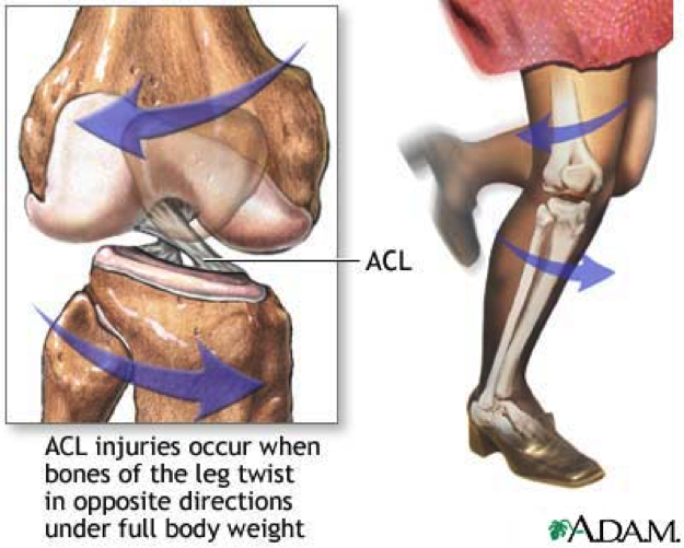 ACL-injuries2