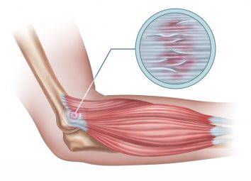 tennis elbow image